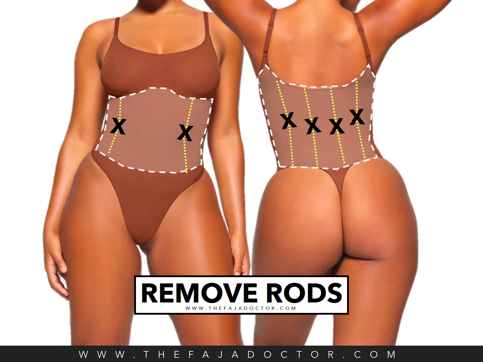 REMOVE FAJA RODS – The Faja Doctor